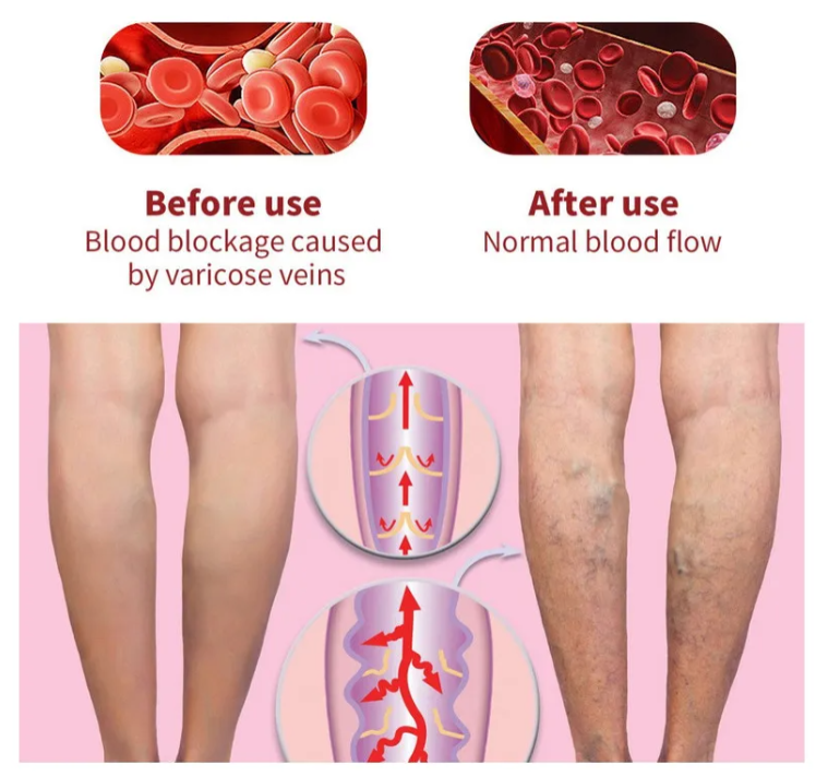 VenoRelief™ 🦵 PIERNAS MÁS LIGERAS, MÁS LIBRES, MÁS BELLAS 🦵