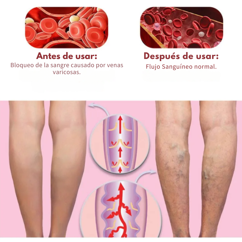 VenoRelief™ 🦵 PIERNAS MÁS LIGERAS, MÁS LIBRES, MÁS BELLAS 🦵